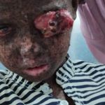 Ringgo Bocah 7 Tahun Asal Pedamaran Butuh Uluran Tangan Pemerintah dan Dermawan